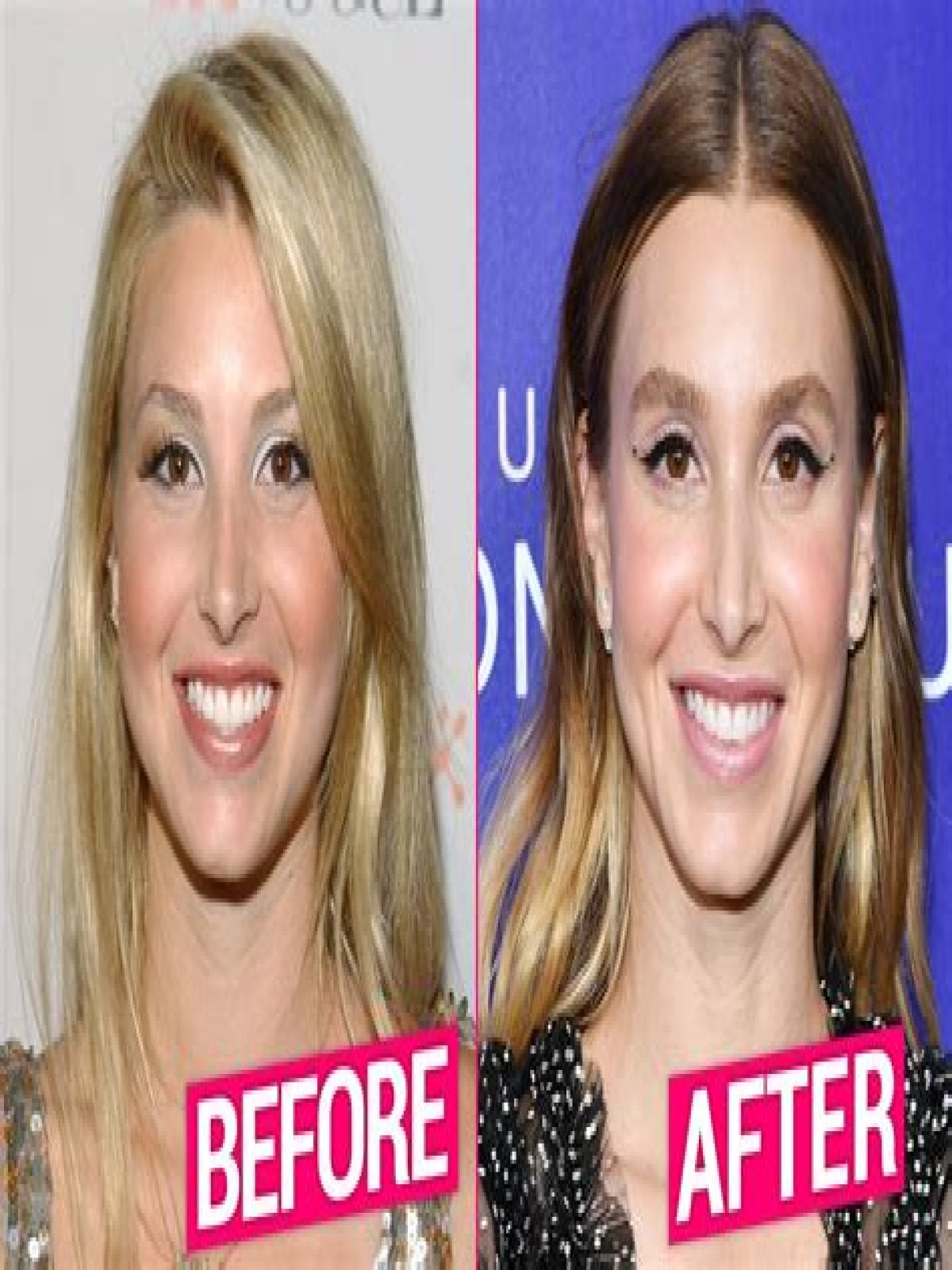 Whitney Port Plastic Surgery Before and After